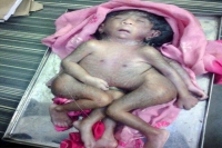 A baby born with four arms and four legs