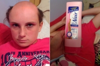 Girl goes bald after mistaking hair removal cream for shampoo
