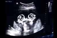 Unborn twin sisters box it out in mom s womb ultrasound video of fiery fight goes viral