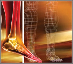 Diabetic_foot