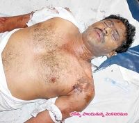 Acid attack on lecturer in guntur