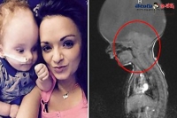 Baby born without a brain