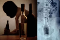 Glass alcohol bottle surgically removed from mans anal cavity
