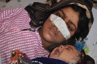 A woman in afghanistan has had her nose cut off by her husband