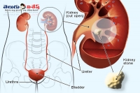 Home remedies to remove kidney stones orange benefits health tips