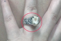 Woman receives wisdom tooth engagement ring