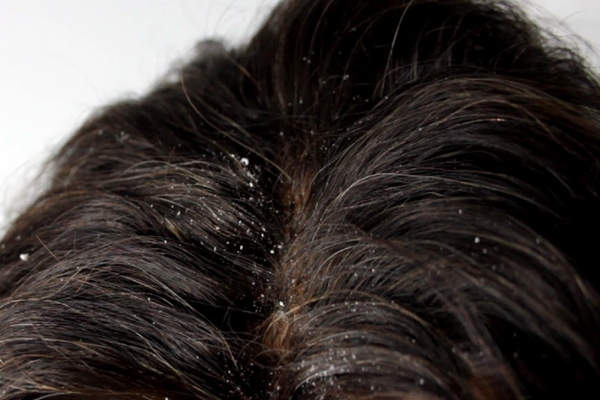 The onion home remedies to remove dandruff problems
