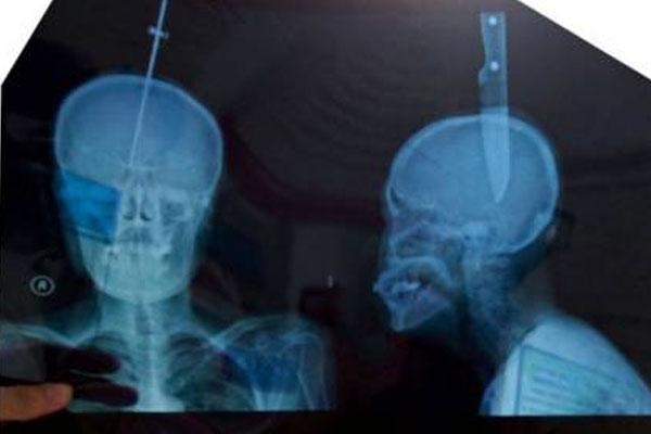 Chinese woman gets impaled with an 11 cm knife in her head after slip