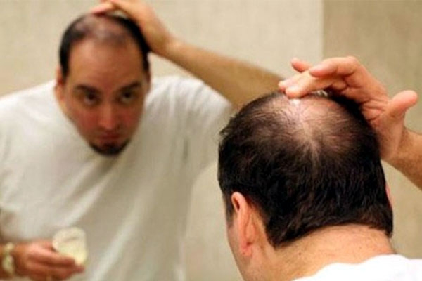 Tips to stop hair loss for men