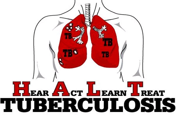 Drug resistant tb rise in the state