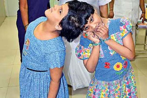 London doctors examined conjoined twins veena vani