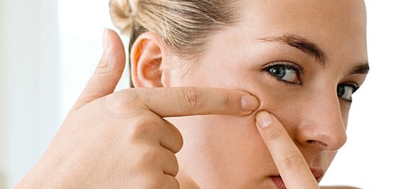 Tips to remove pimples