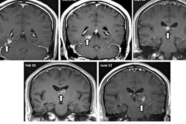 Rare tapeworm found living in british man s brain after four years of pain
